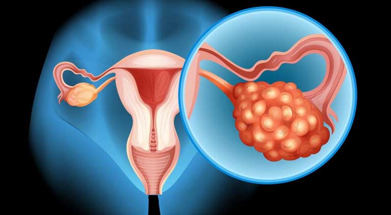 Read more about the article Can endometriosis cause cancer?