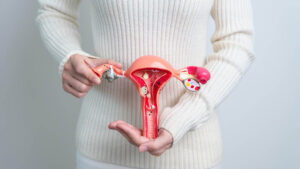 Read more about the article IVF and PCOS – what do women need to know?